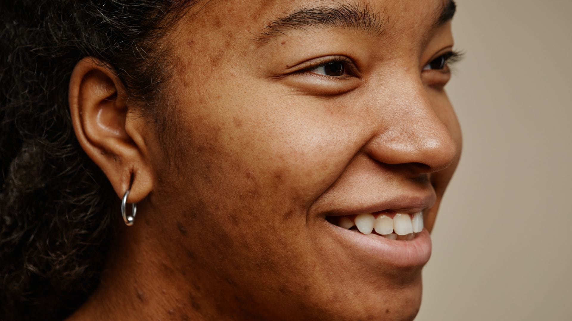 Smiling young woman with acne-prone skin, showcasing improved clarity and texture after acne treatment facials, highlighting the benefits of professional skin care.