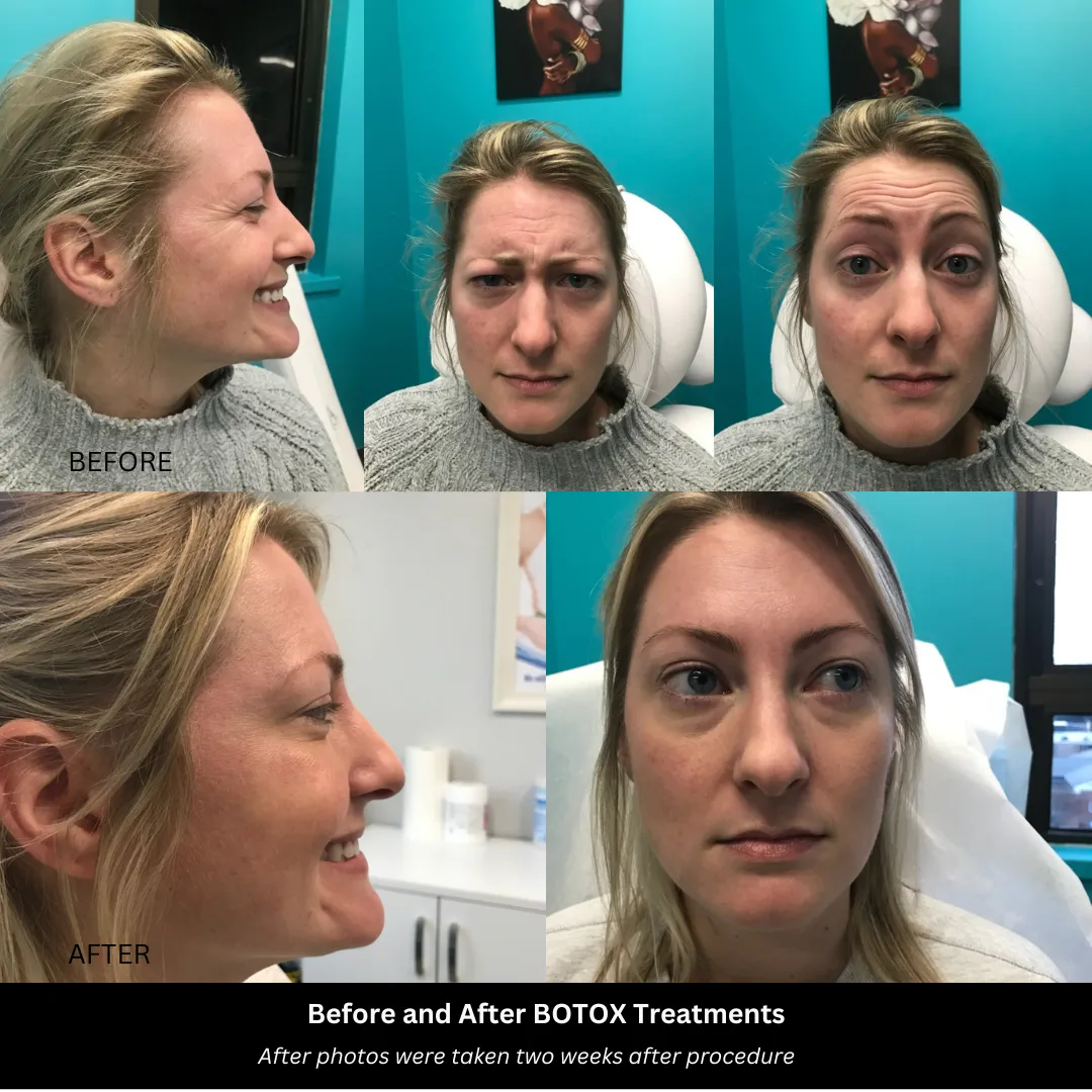 Natural-looking Botox results at Body Scientific Aesthetics in Timonium