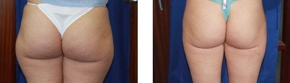 Butt lifting, sculpting, and tightening treatment in Timonium, Maryland