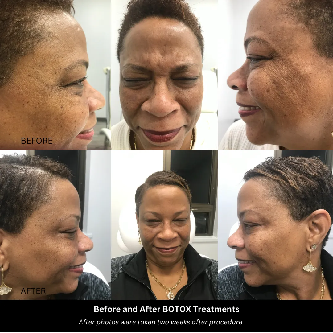 Licensed Nurse Practitioner administering Botox in Timonium