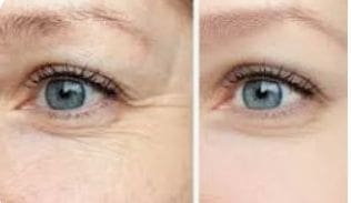 welcome to body scientific aesthetics, where beauty meets science in the pursuit of aesthetic excellence, botox crows feet