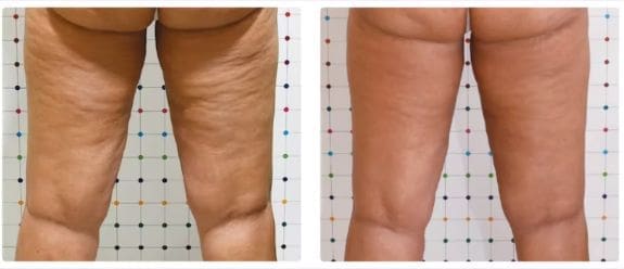 introduction, celulite removal