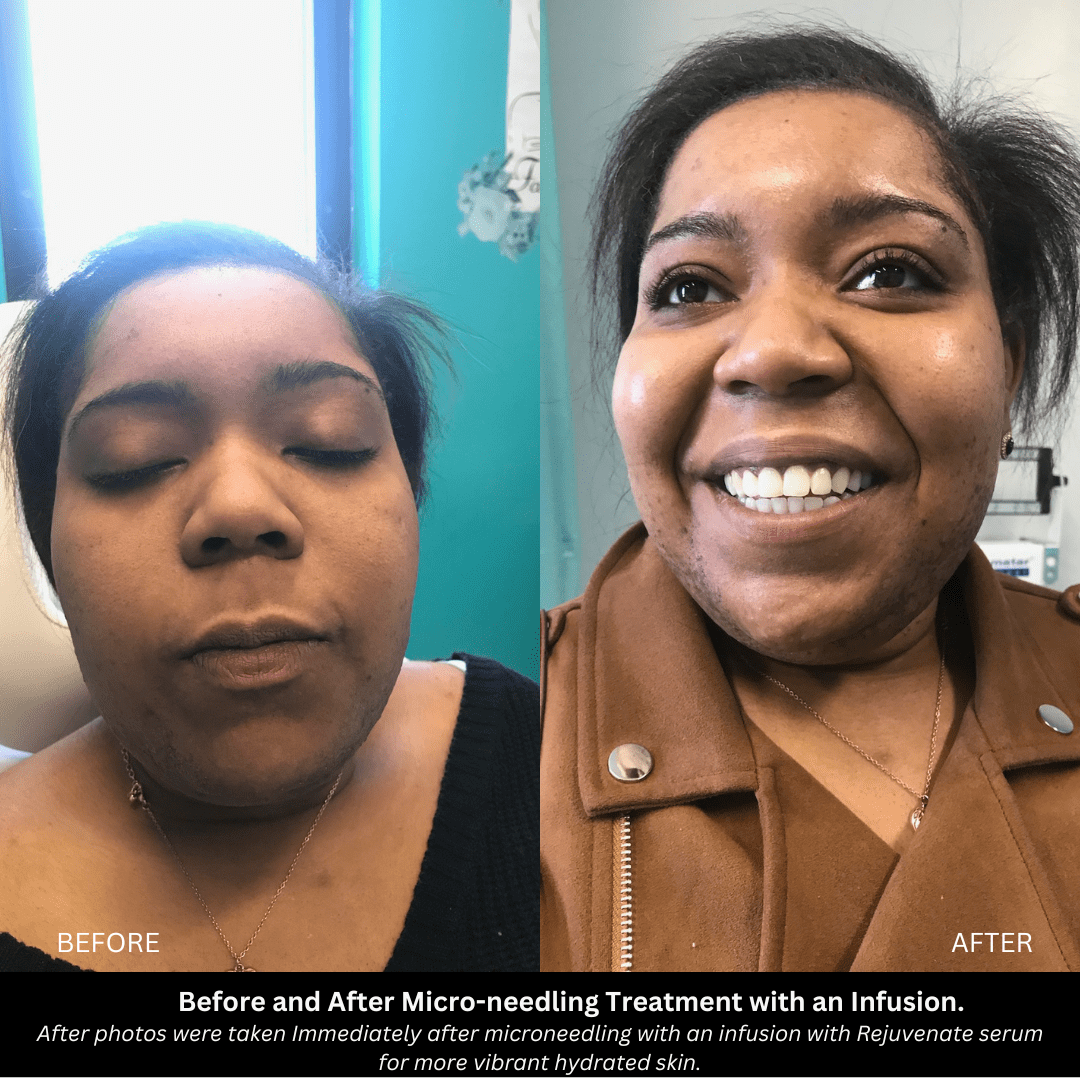 Skin texture improvement with microdermabrasion in Timonium