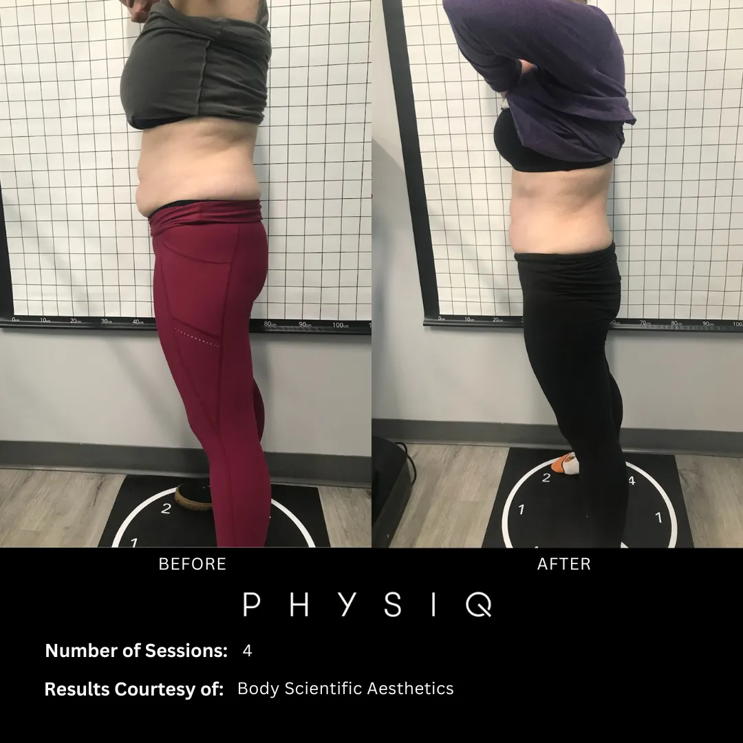 Client receiving body sculpting treatment in Timonium