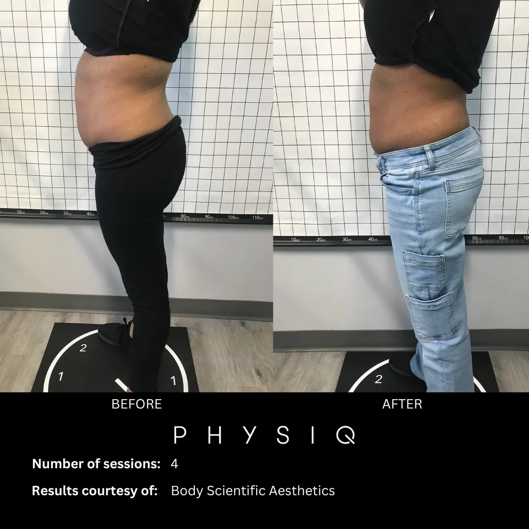 Body sculpting procedure at Body Scientific Aesthetics in Timonium