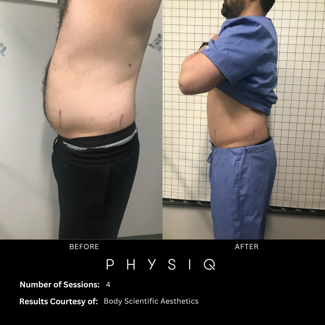 Before and after body sculpting results in Timonium