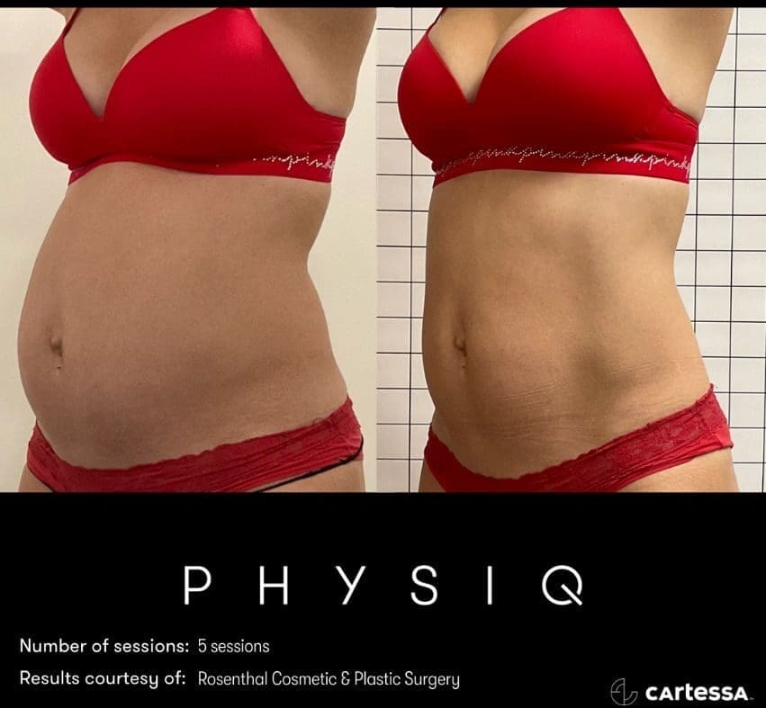 Physiq vs Morpheus8 body contouring comparison in Timonium, Maryland