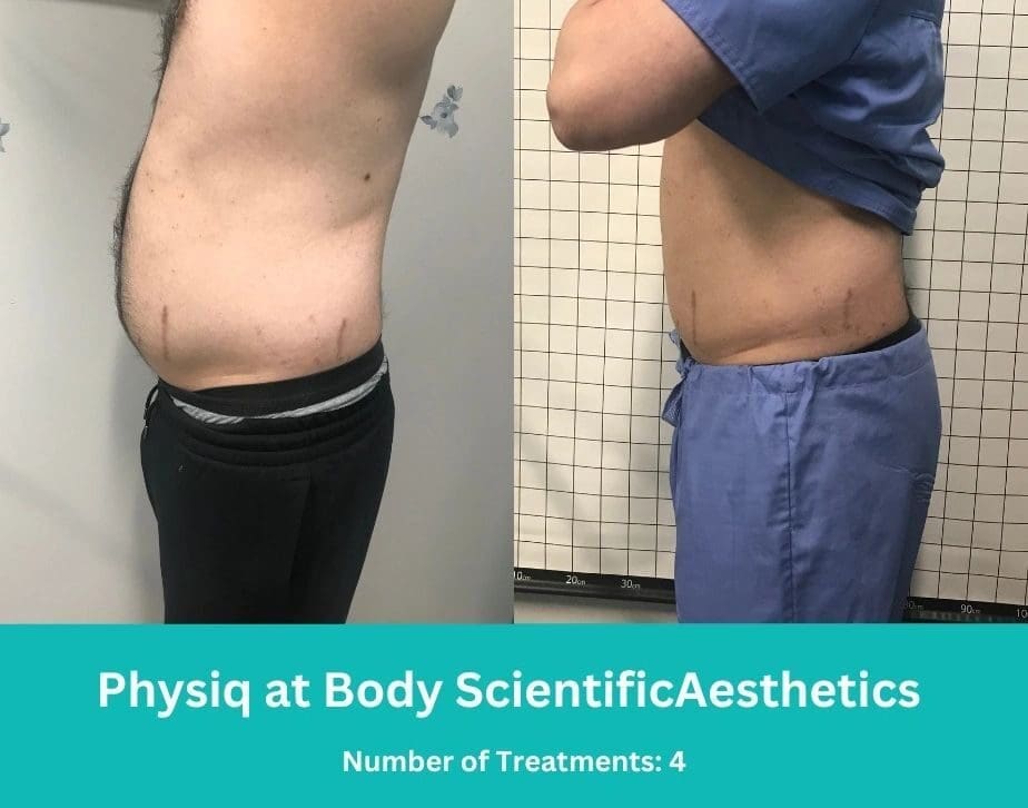 Reasons PhysIQ is superior to CoolSculpting in Timonium, Maryland