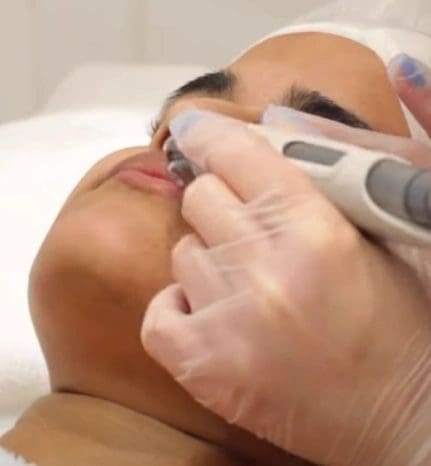 Skin rejuvenation therapy at Body Scientific Aesthetics in Timonium, Maryland