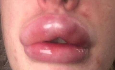 Lip filler correction and natural results in Baltimore City