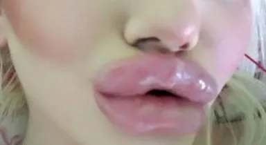 Natural-looking lip filler treatments in Baltimore County