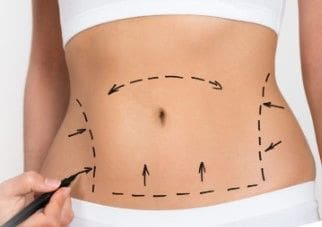 Body sculpting before undergoing a tummy tuck in Timonium, Maryland