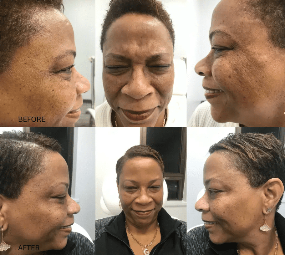 Before and after photos show a woman's facial transformation.