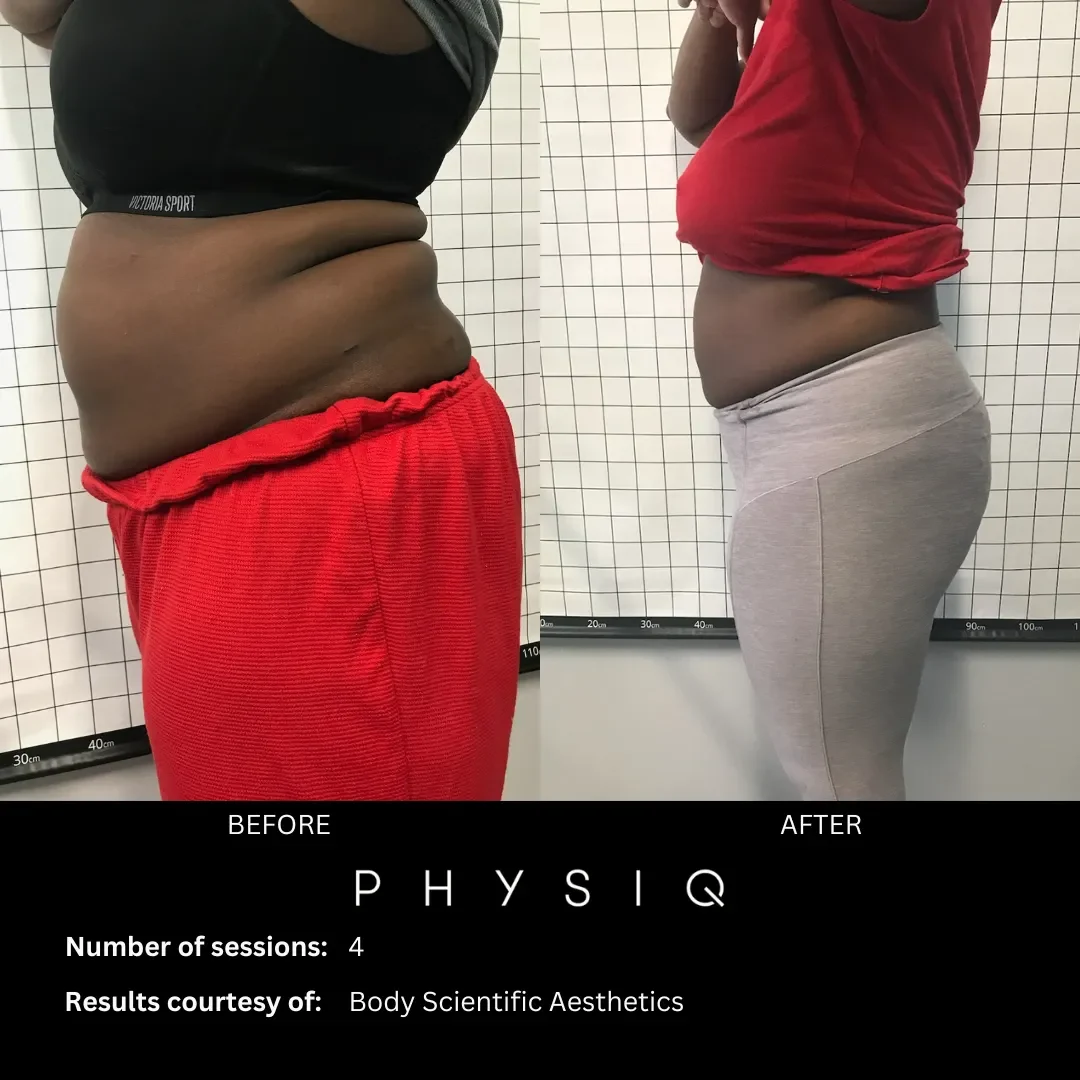 Safe and effective fat reduction treatment in Timonium