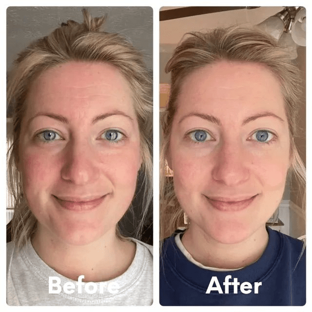Before and after microneedling results in Timonium, Maryland